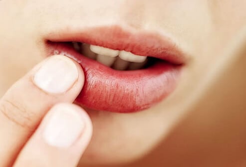 what causes cold sores